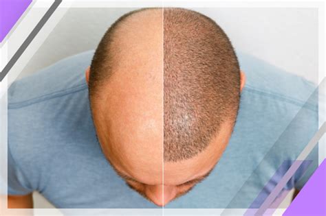scalp micropigmentation regrets|Scalp Micropigmentation Regrets & How to Prevent Them .